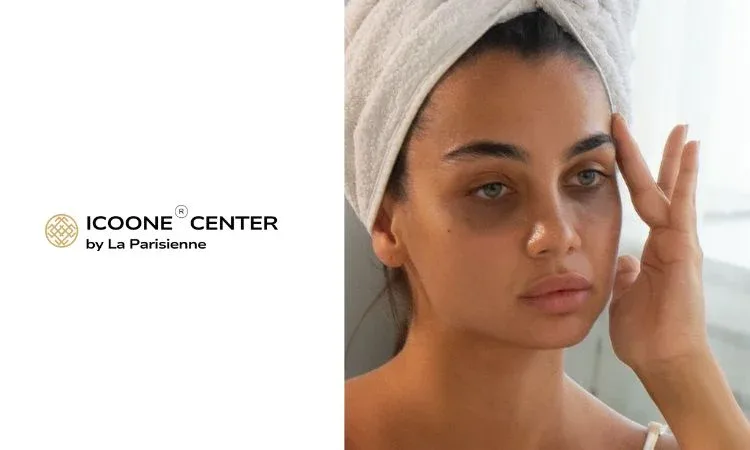 Why Do We Have Dark Circles?