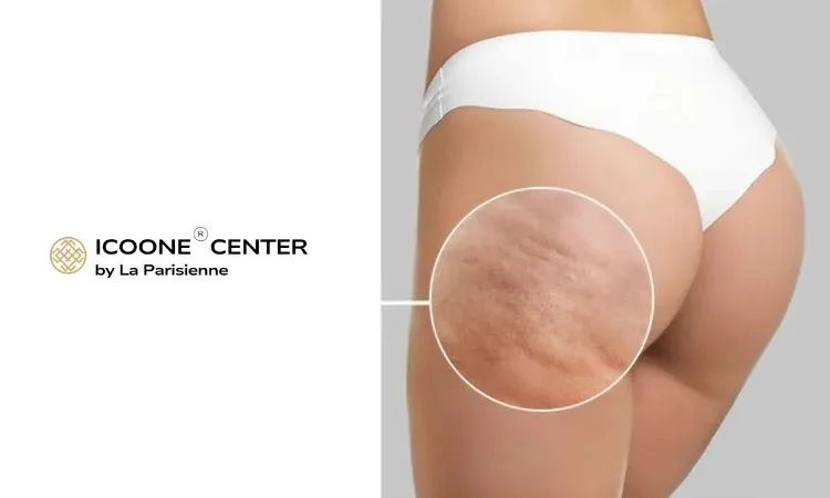 Why Do Women Have Cellulite?